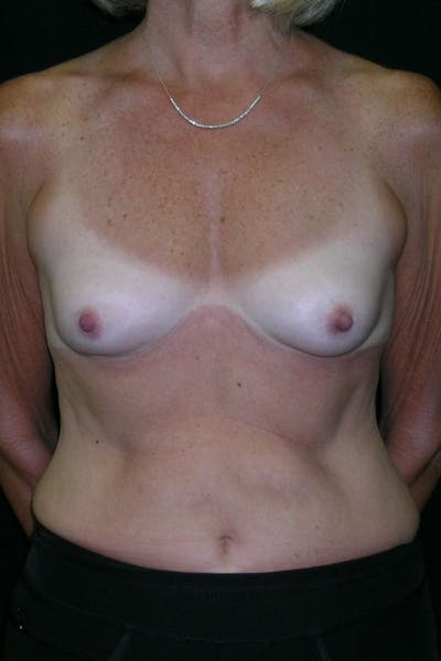 Breast Augmentation Before & After Gallery - Patient 23533199 - Image 1