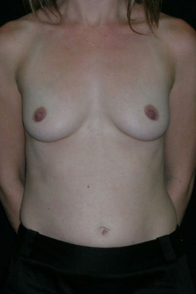 Breast Augmentation Before & After Gallery - Patient 23533220 - Image 1