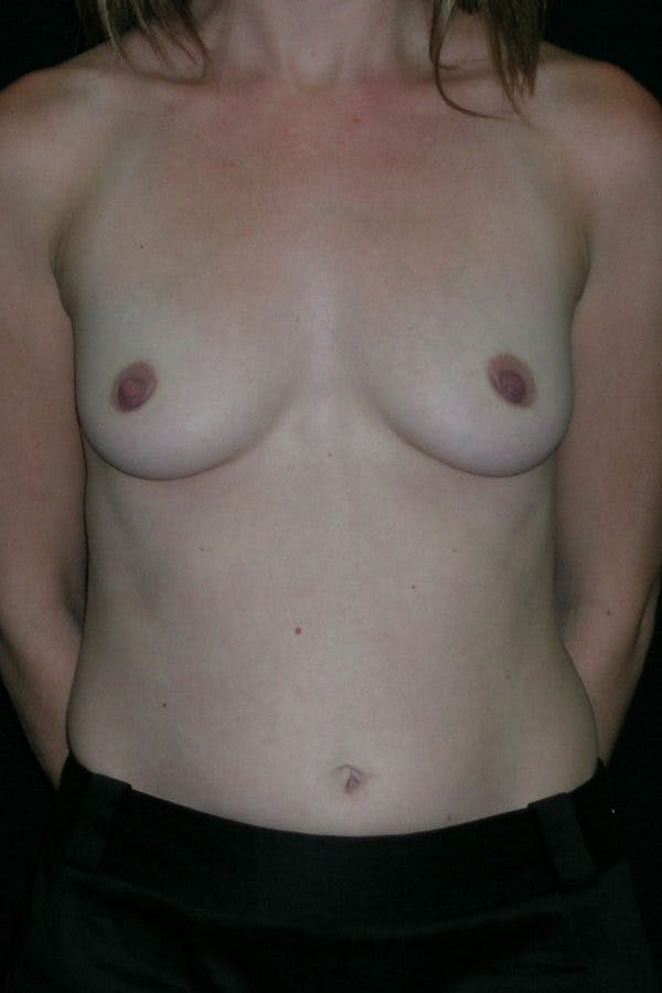 Breast Augmentation Before & After Gallery - Patient 23533220 - Image 1