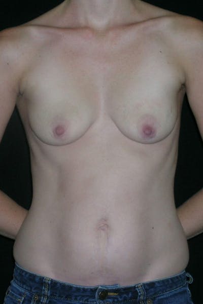 Breast Augmentation Before & After Gallery - Patient 23533240 - Image 1