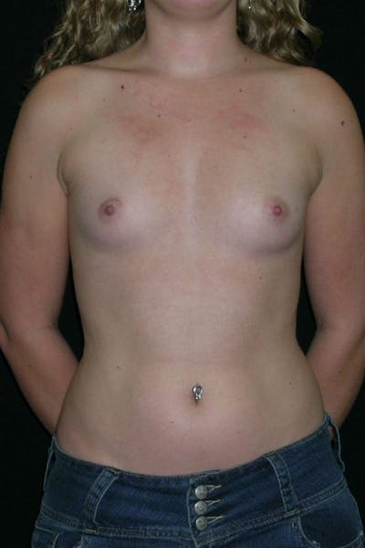 Breast Augmentation Before & After Gallery - Patient 23533243 - Image 1