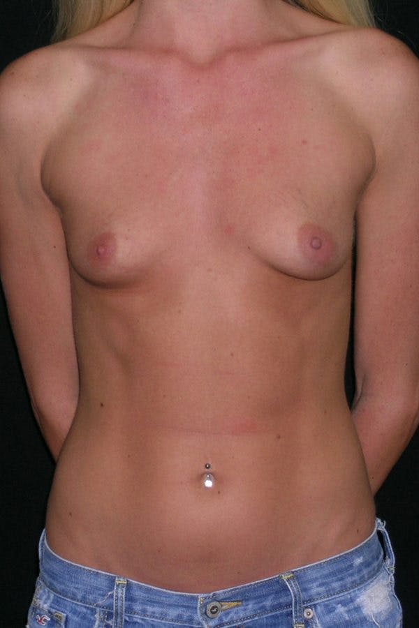 Breast Augmentation Before & After Gallery - Patient 23533251 - Image 1