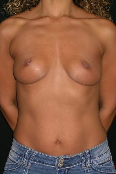 Breast Augmentation Before & After Gallery - Patient 23533264 - Image 1