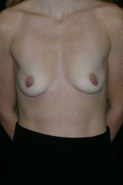 Breast Augmentation Before & After Gallery - Patient 23533265 - Image 1