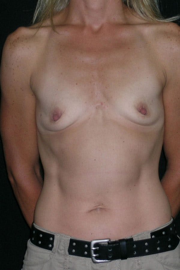 Breast Augmentation Before & After Gallery - Patient 23533267 - Image 1