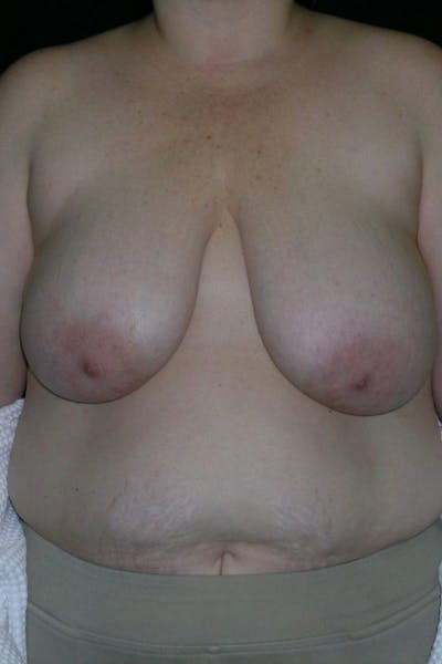 Breast Augmentation Before & After Gallery - Patient 23533273 - Image 1
