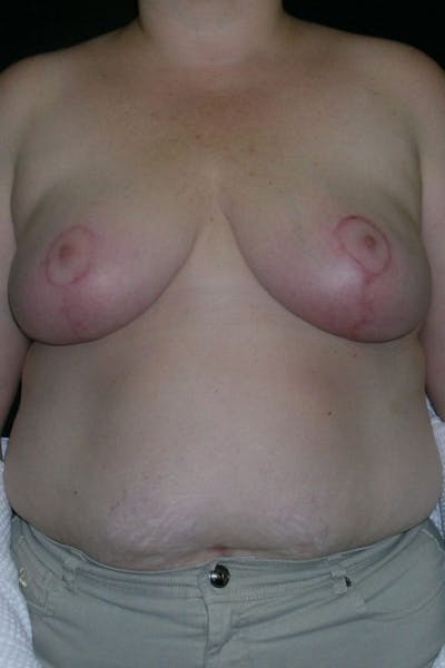 Breast Augmentation Before & After Gallery - Patient 23533273 - Image 2