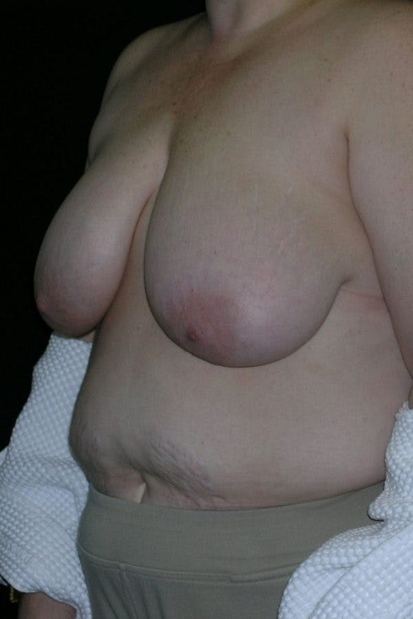 Breast Augmentation Gallery - Patient 23533273 - Image 3