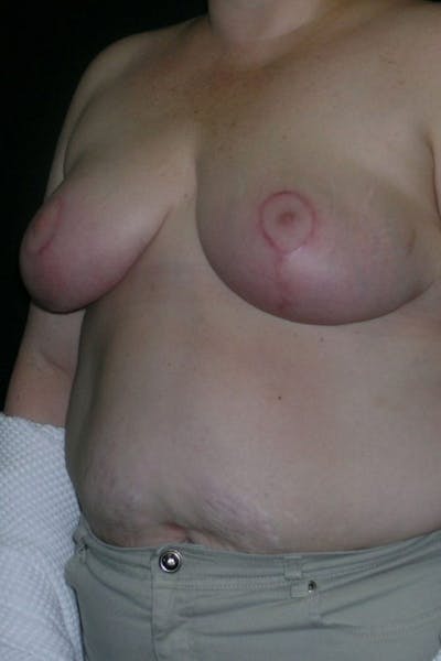Breast Augmentation Before & After Gallery - Patient 23533273 - Image 4