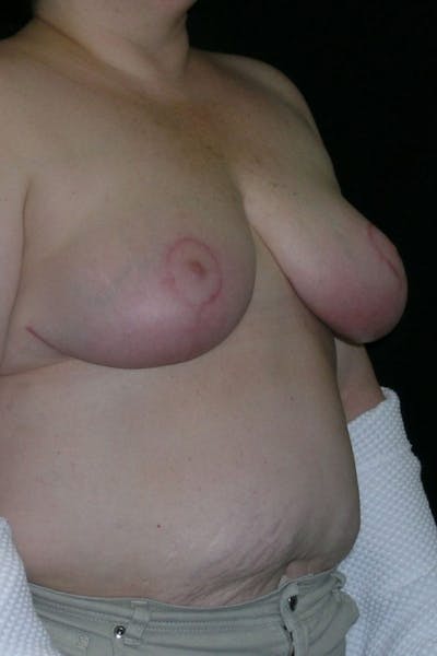 Breast Augmentation Before & After Gallery - Patient 23533273 - Image 6