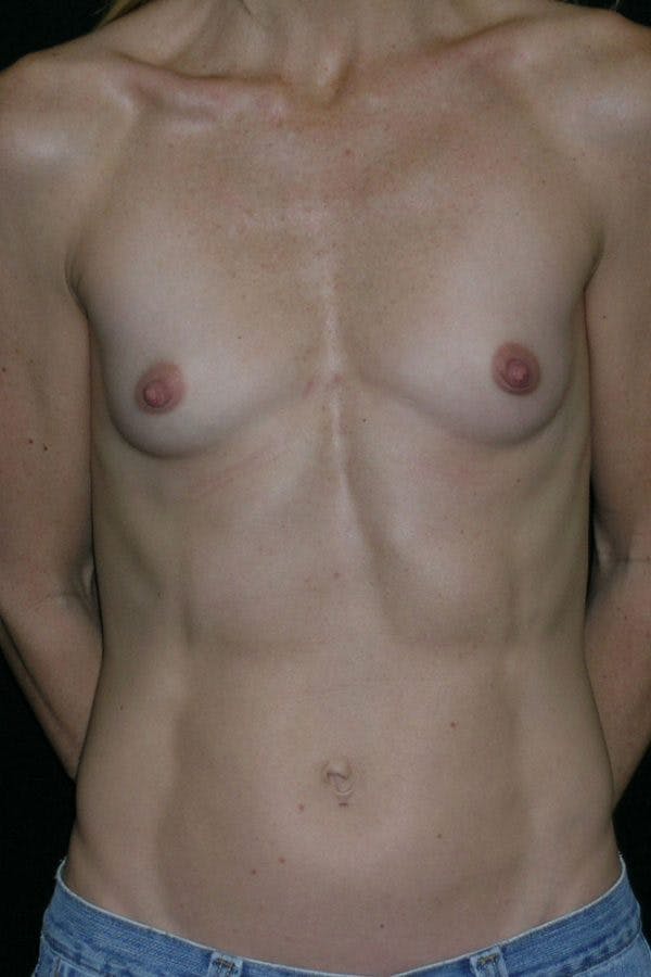 Breast Augmentation Before & After Gallery - Patient 23533275 - Image 1