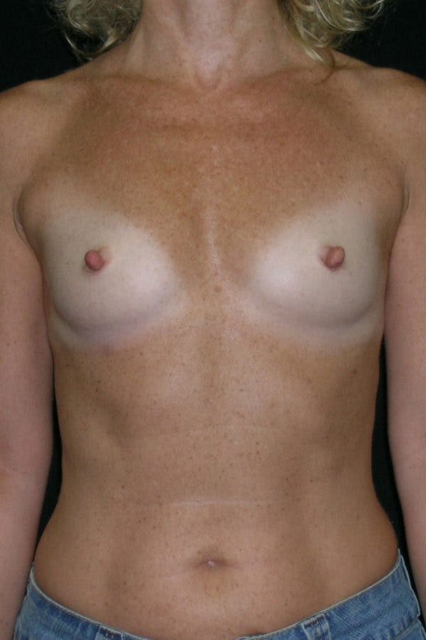Breast Augmentation Before & After Gallery - Patient 23533294 - Image 1