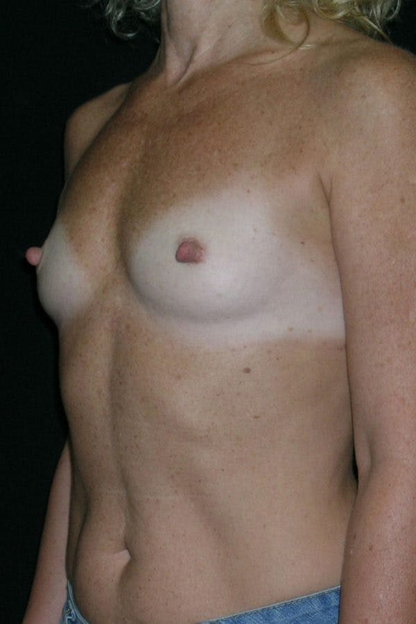 Breast Augmentation Before & After Gallery - Patient 23533294 - Image 3