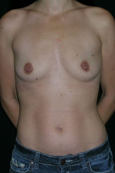 Breast Augmentation Before & After Gallery - Patient 23533327 - Image 1