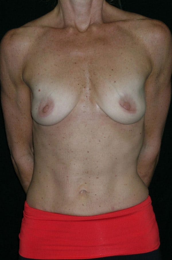 Breast Augmentation Before & After Gallery - Patient 23533335 - Image 1