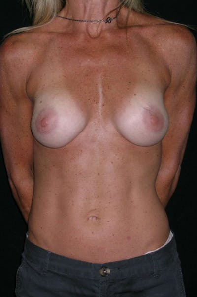 Breast Augmentation Before & After Gallery - Patient 23533335 - Image 2