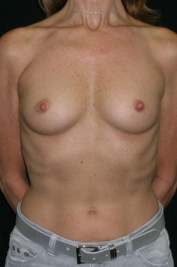 Breast Augmentation Before & After Gallery - Patient 23533381 - Image 1