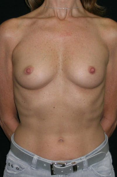Breast Augmentation Before & After Gallery - Patient 23533381 - Image 1