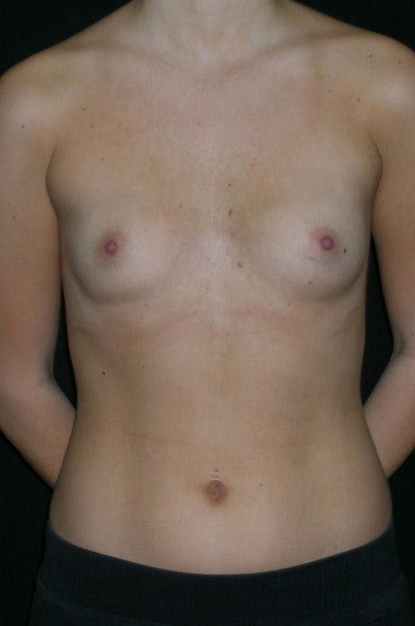 Breast Augmentation Before & After Gallery - Patient 23533415 - Image 1