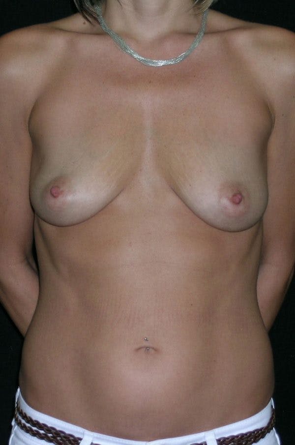 Breast Augmentation Before & After Gallery - Patient 23533551 - Image 1