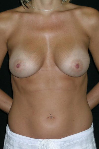 Breast Augmentation Before & After Gallery - Patient 23533551 - Image 2