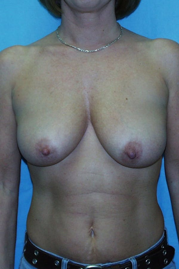 Mastopexy Before & After Gallery - Patient 23533717 - Image 1