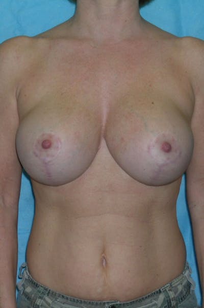 Mastopexy Before & After Gallery - Patient 23533717 - Image 2