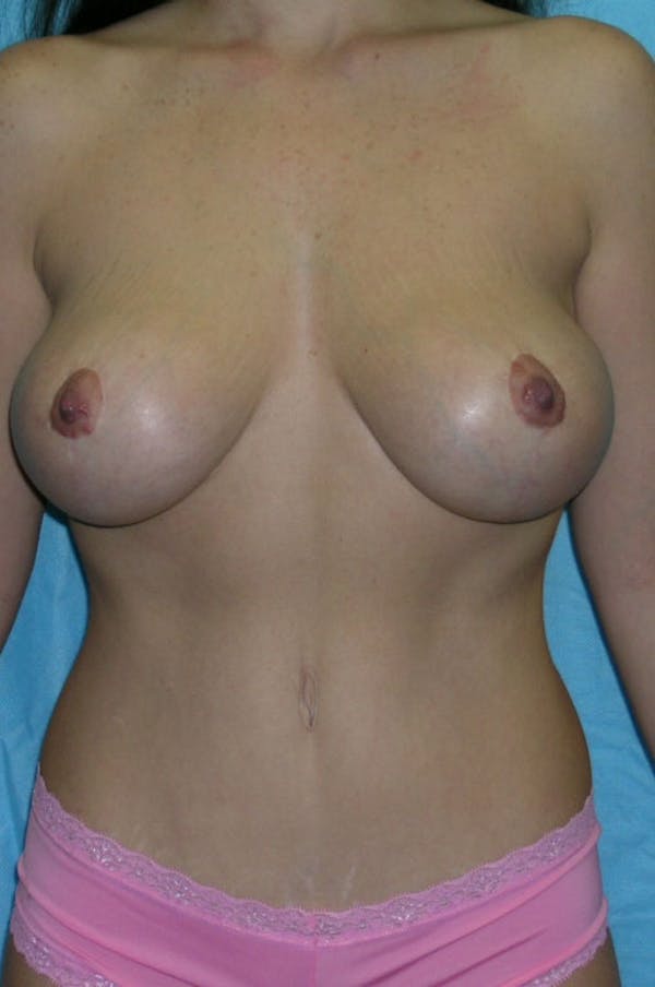 Mastopexy Before & After Gallery - Patient 23533775 - Image 2