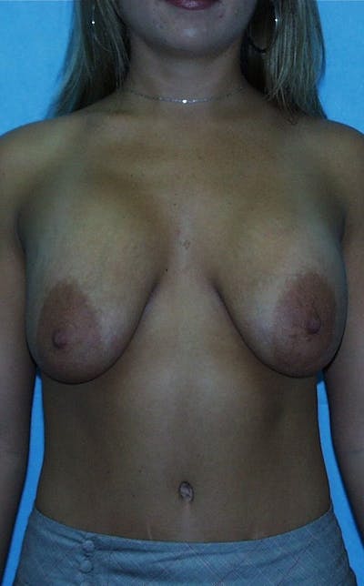 Mastopexy Before & After Gallery - Patient 23533781 - Image 1