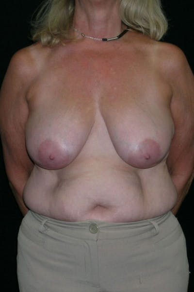 Mastopexy Before & After Gallery - Patient 23533791 - Image 1