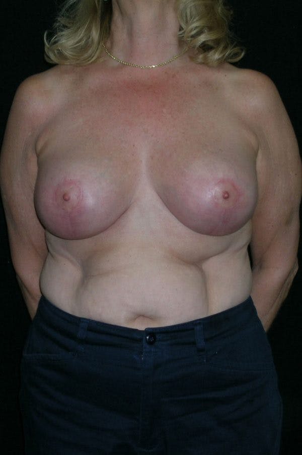 Mastopexy Before & After Gallery - Patient 23533791 - Image 2