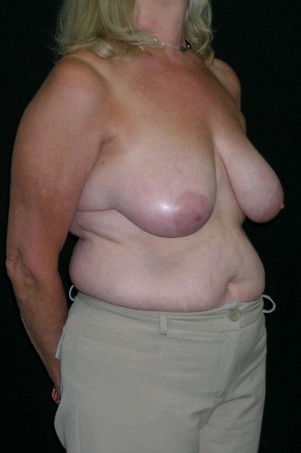 Mastopexy Before & After Gallery - Patient 23533791 - Image 3