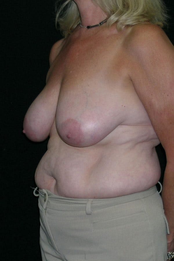 Mastopexy Before & After Gallery - Patient 23533791 - Image 5