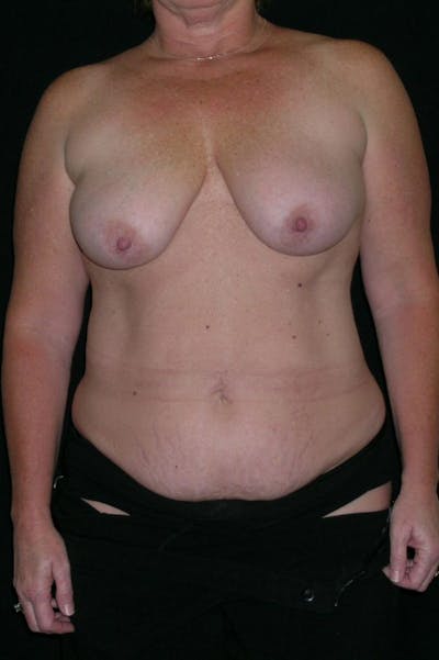 Mastopexy Before & After Gallery - Patient 23533798 - Image 1