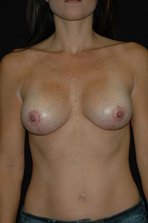 Mastopexy Before & After Gallery - Patient 23533801 - Image 2
