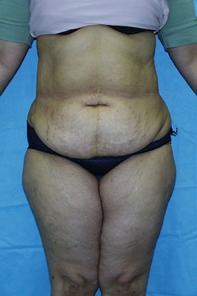 Tummy Tuck Before & After Gallery - Patient 23533813 - Image 1