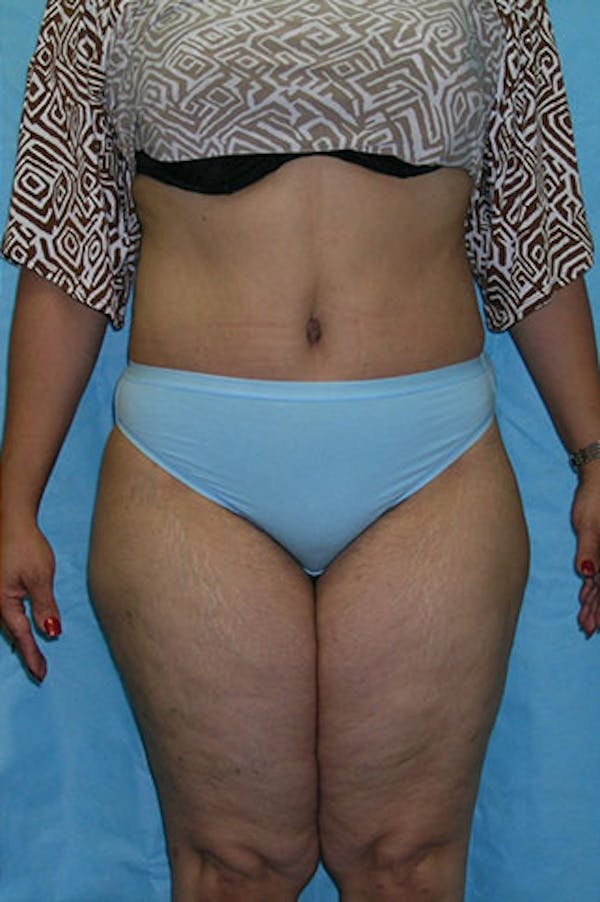 Tummy Tuck Before & After Gallery - Patient 23533813 - Image 2