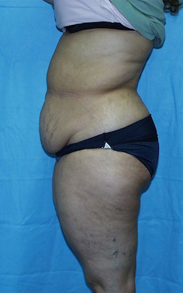 Tummy Tuck Before & After Gallery - Patient 23533813 - Image 3