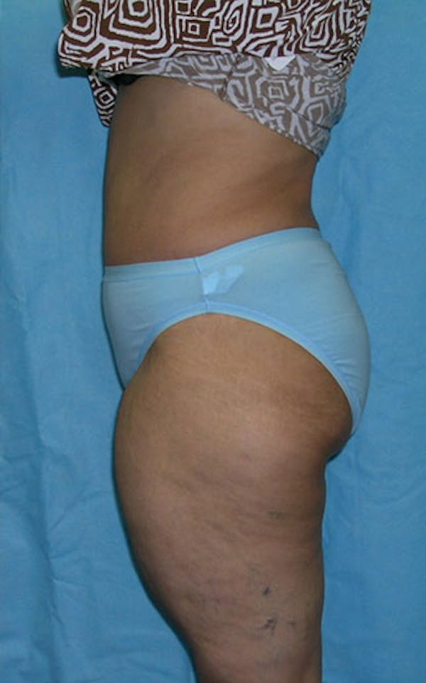 Tummy Tuck Gallery - Patient 23533813 - Image 4