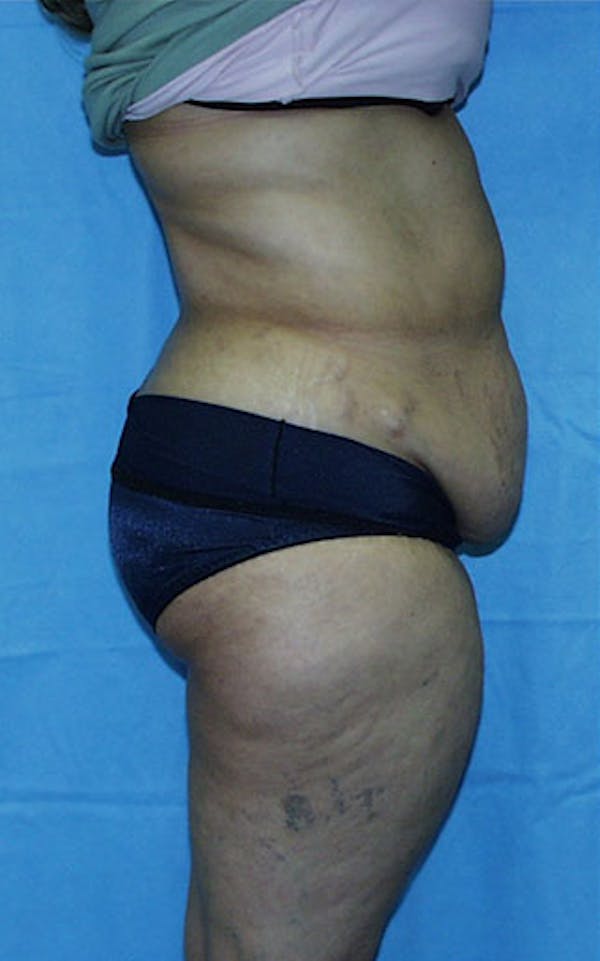 Tummy Tuck Before & After Gallery - Patient 23533813 - Image 5