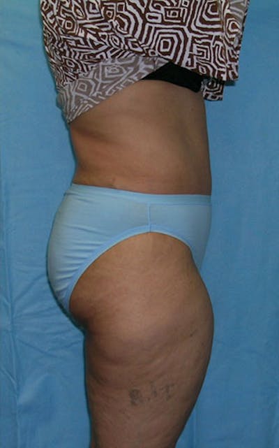 Tummy Tuck Before & After Gallery - Patient 23533813 - Image 6