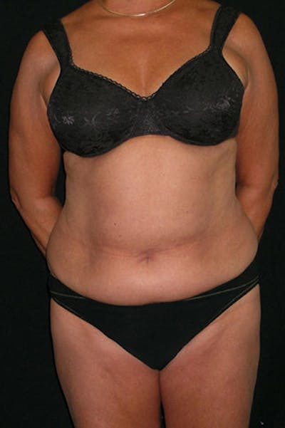 Tummy Tuck Before & After Gallery - Patient 23533814 - Image 1