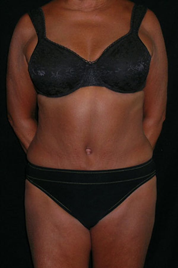 Tummy Tuck Before & After Gallery - Patient 23533814 - Image 2