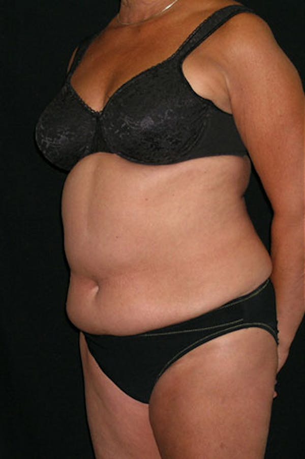 Tummy Tuck Before & After Gallery - Patient 23533814 - Image 3