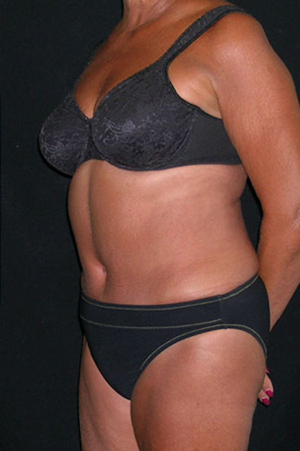 Tummy Tuck Before & After Gallery - Patient 23533814 - Image 4