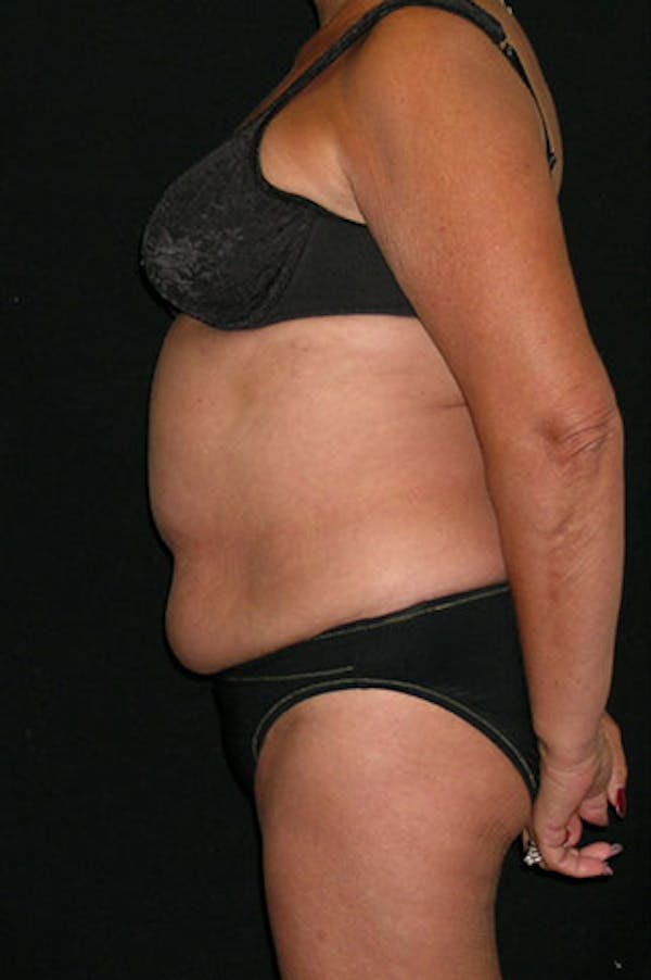 Tummy Tuck Before & After Gallery - Patient 23533814 - Image 5