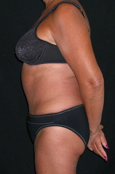 Tummy Tuck Before & After Gallery - Patient 23533814 - Image 6