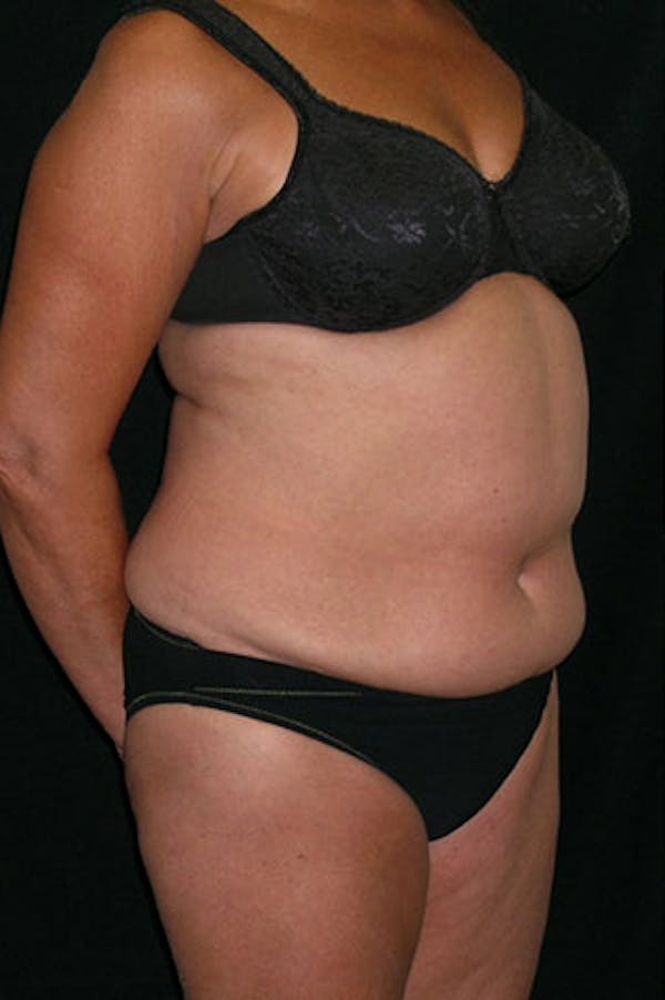 Tummy Tuck Before & After Gallery - Patient 23533814 - Image 7