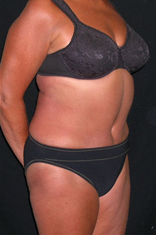 Tummy Tuck Before & After Gallery - Patient 23533814 - Image 8