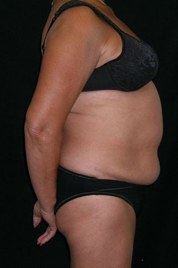 Tummy Tuck Before & After Gallery - Patient 23533814 - Image 9